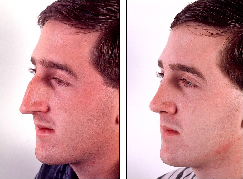 rhinoplasty_4642419627b